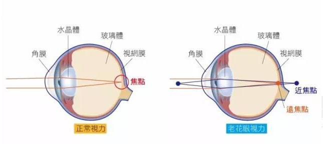 白內障和老花眼區別，老花眼發(fā)病率正呈現年輕化趨勢